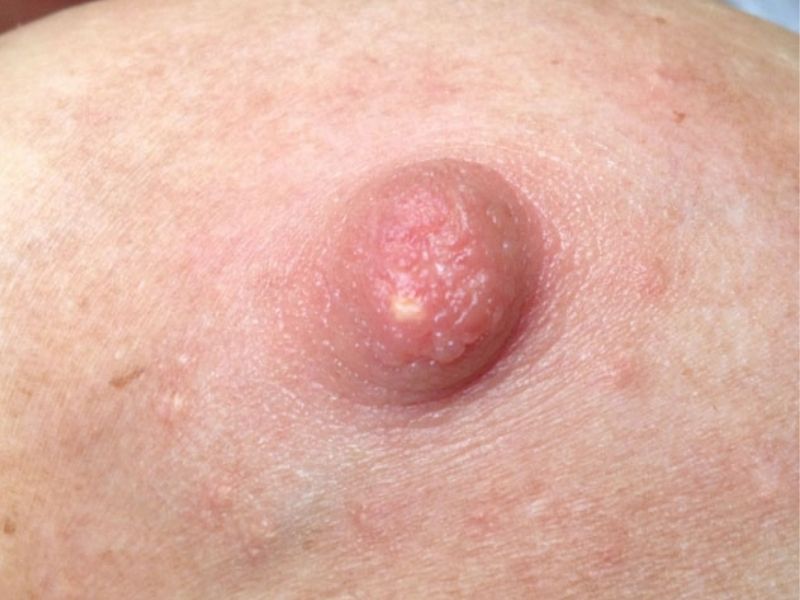 Milchbläschen (Nipple Bleb): Kleiner weißer Punkt auf der Brustwarze