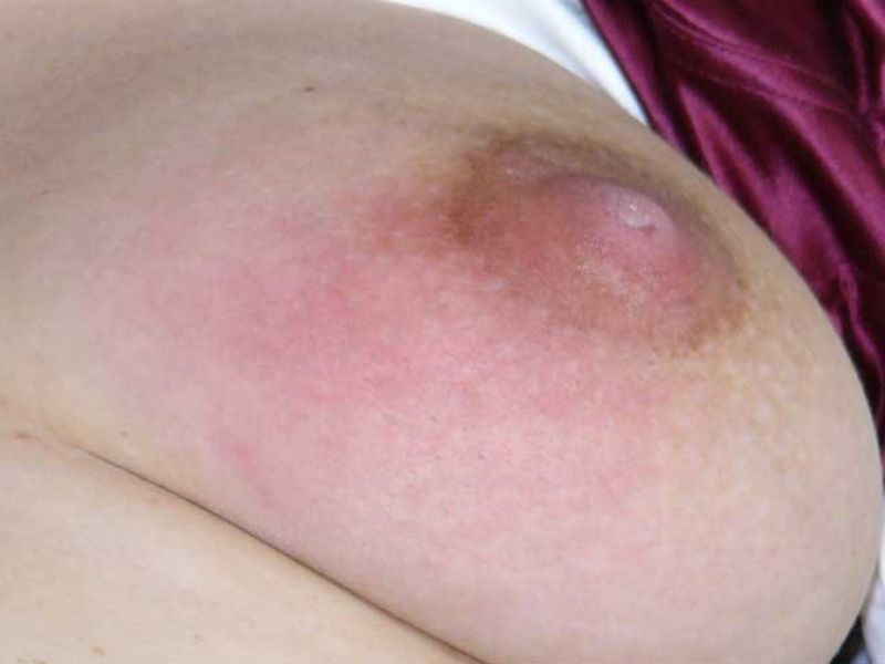 Milchstau: Verhärtete Stelle an der Brust, Rötung und Schwellung sichtbar